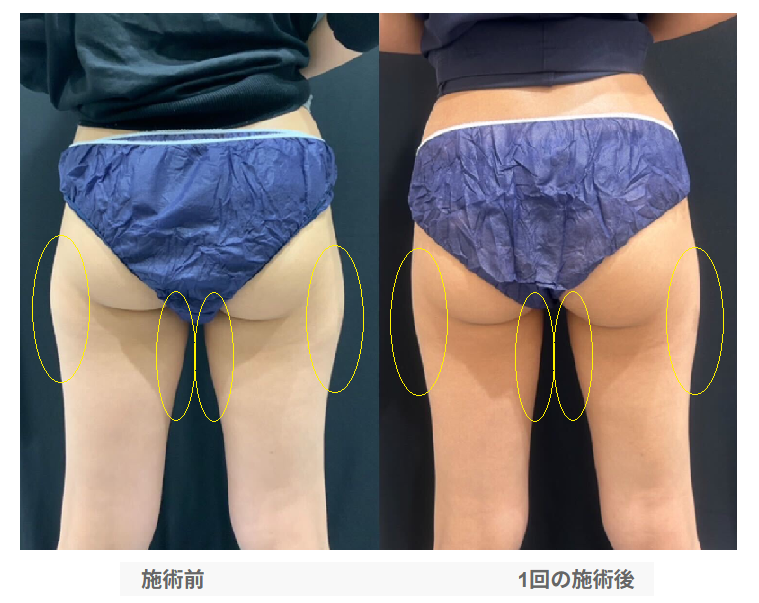 クールスカルプティング®エリート