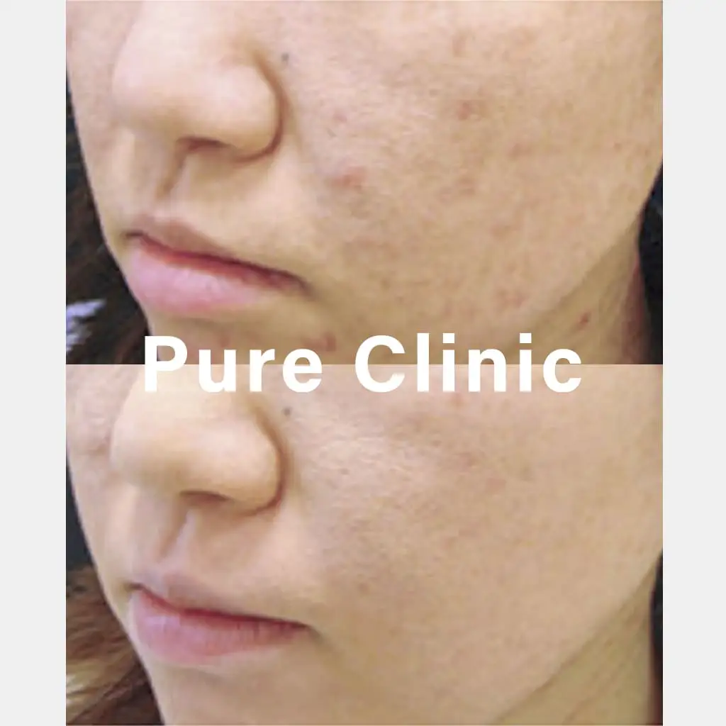 ジェネシスによるにきび・にきび跡の改善