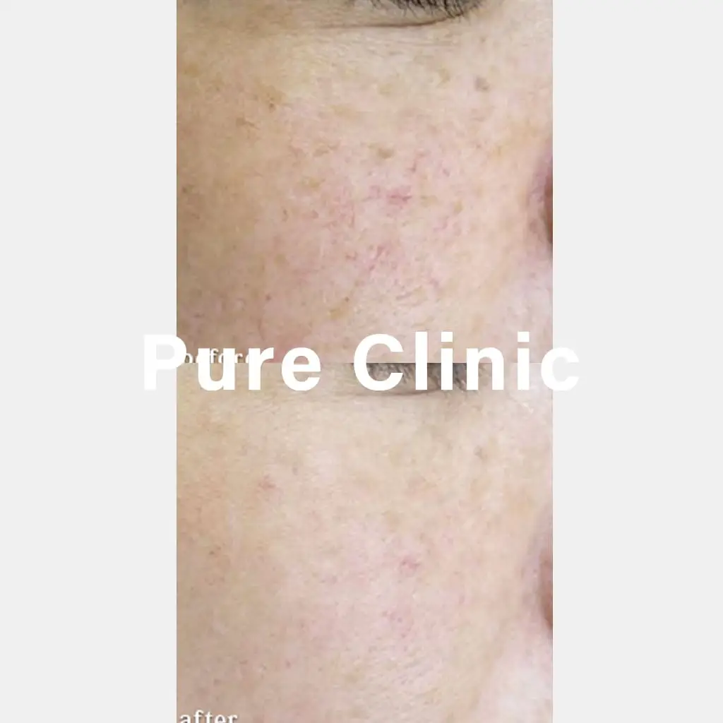 ジェネシスによる毛細血管拡張の改善