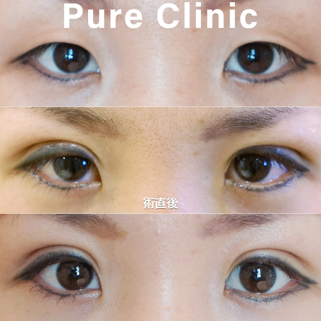 二重埋没法（3点留め）