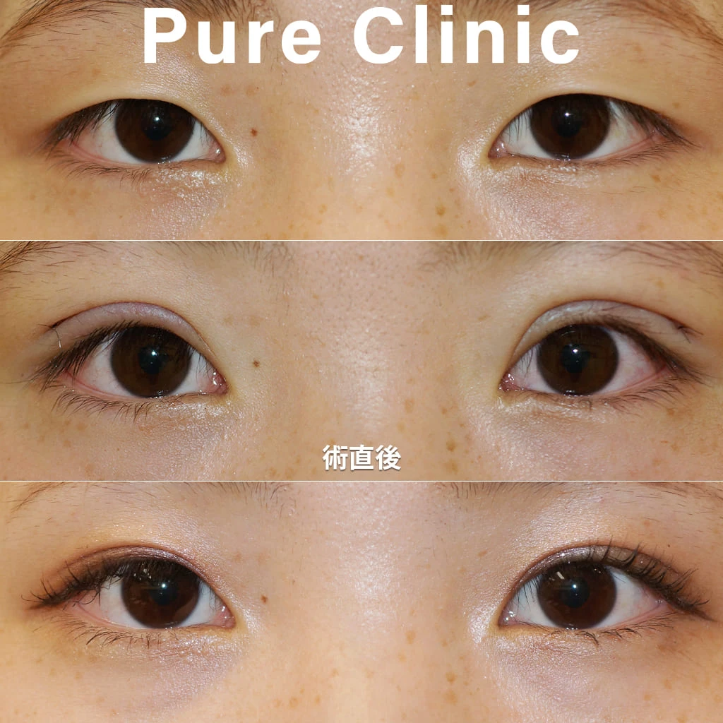 全切開+脱脂による二重形成