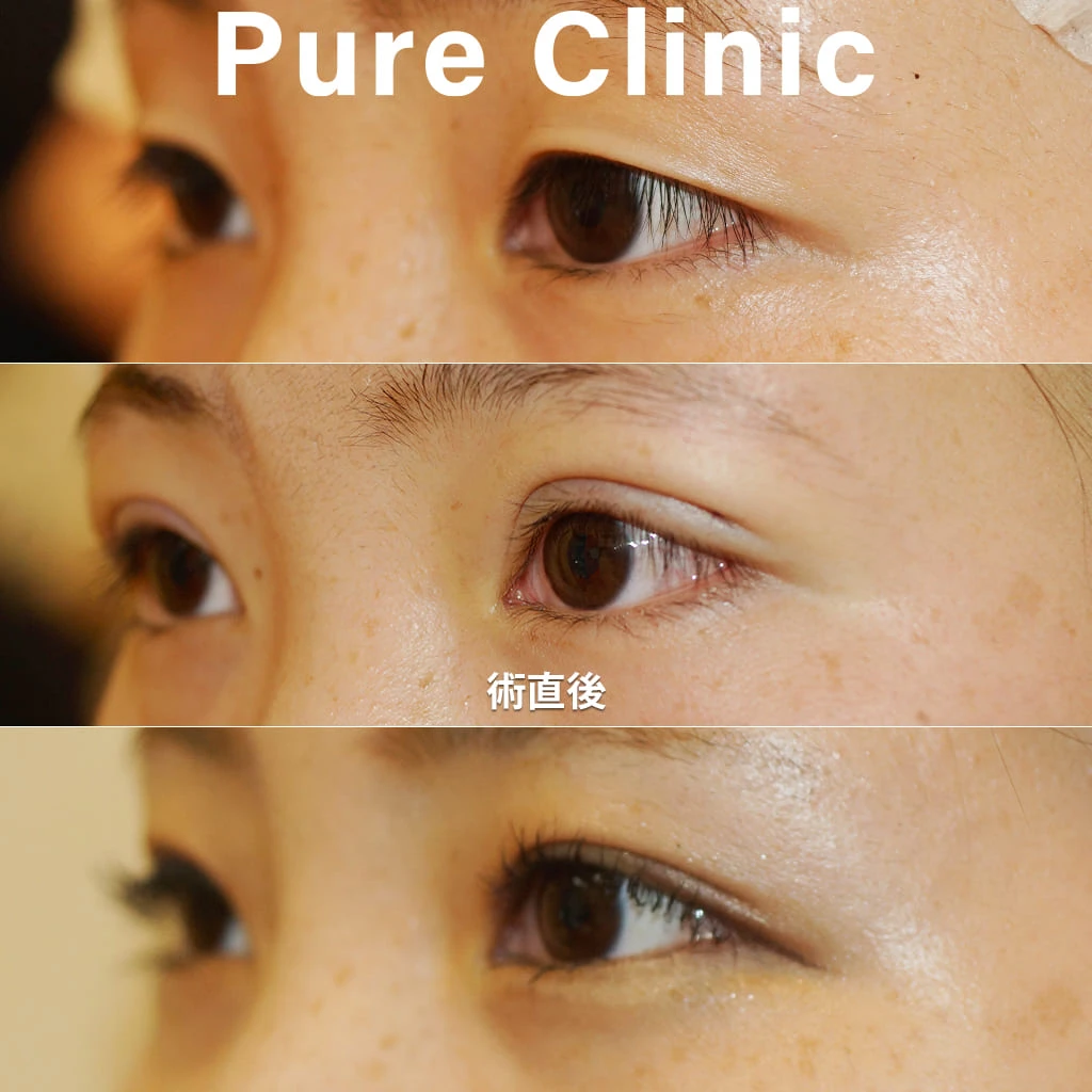 全切開+脱脂による二重形成