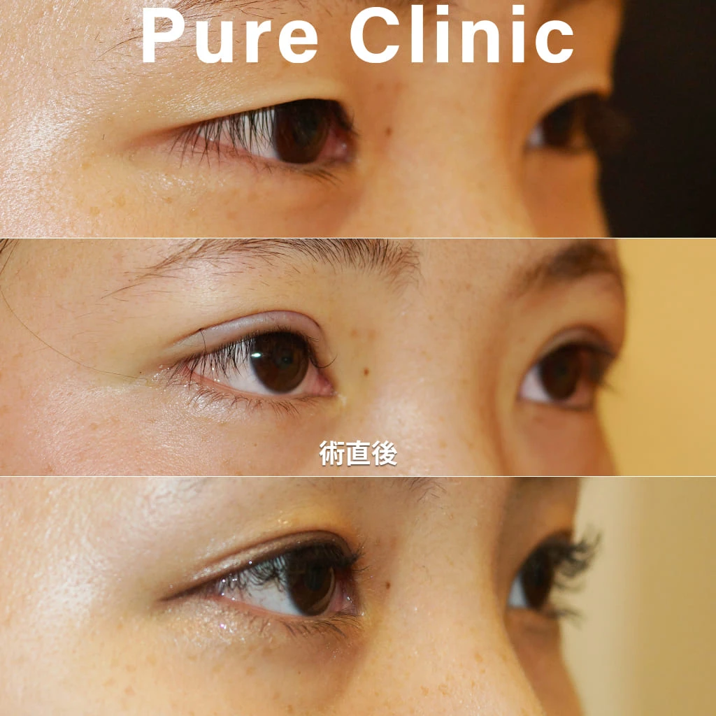 全切開+脱脂による二重形成