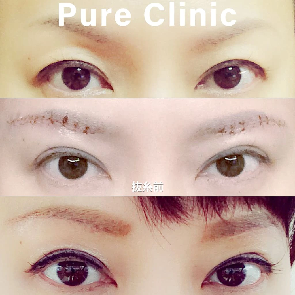 眉毛下リフトによるたるみ改善