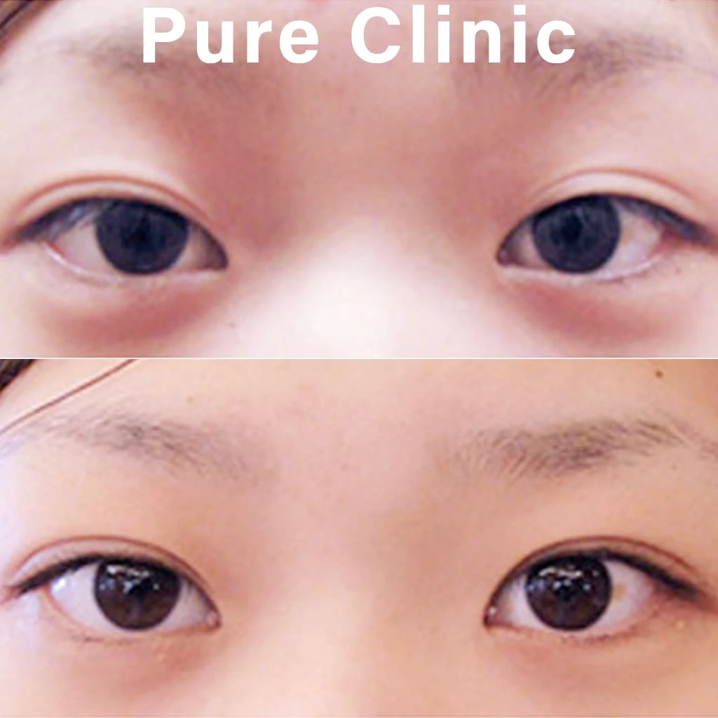 二重埋没法による二重形成