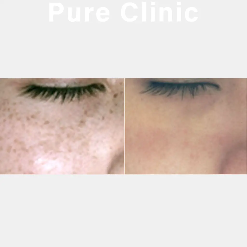 ライムライトによるそばかすの改善