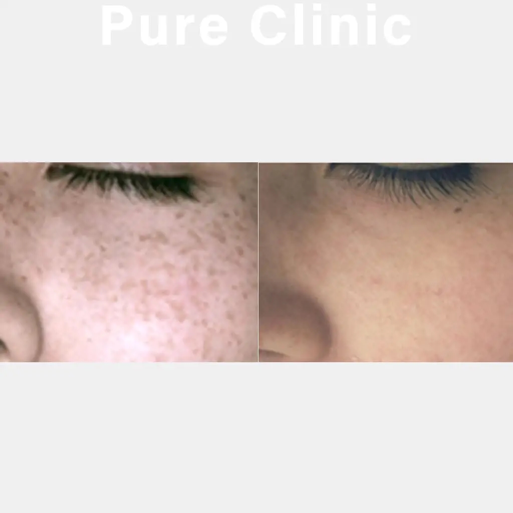 ライムライトによるそばかすの改善