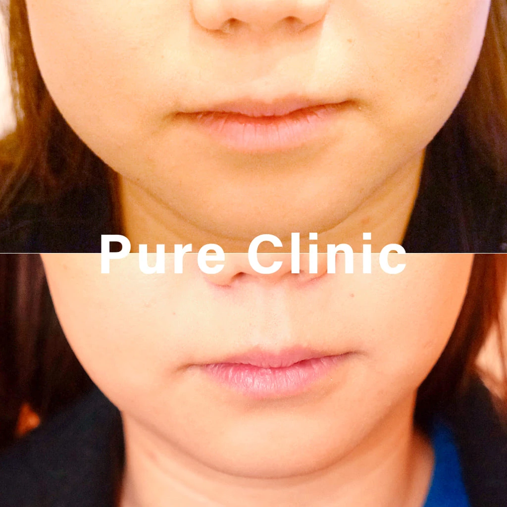 ボツリヌストキシン製剤