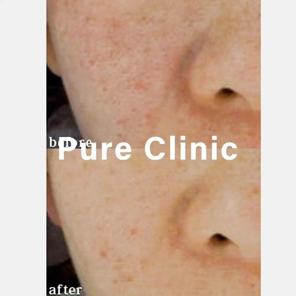 ジェネシスによる毛穴の開き・赤みの改善