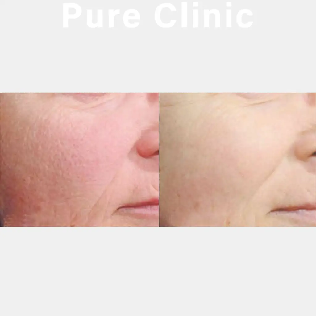 イオン導入による毛穴・ハリ・小じわの改善