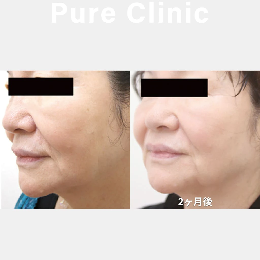 ウルトラセルＱ+によるたるみの改善