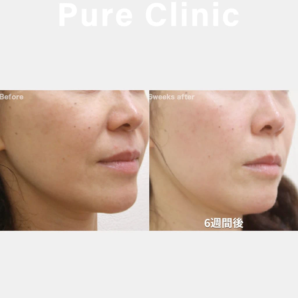 ウルトラセルＱ+によるたるみの改善