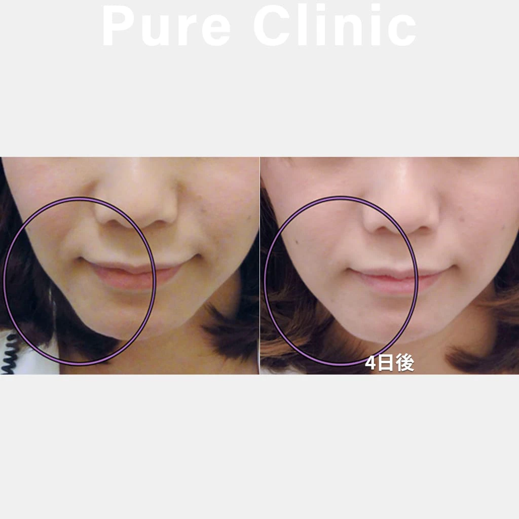 糸リフトによるたるみの改善