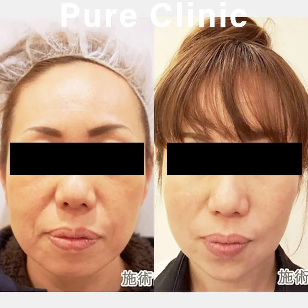 糸リフトによるたるみの改善