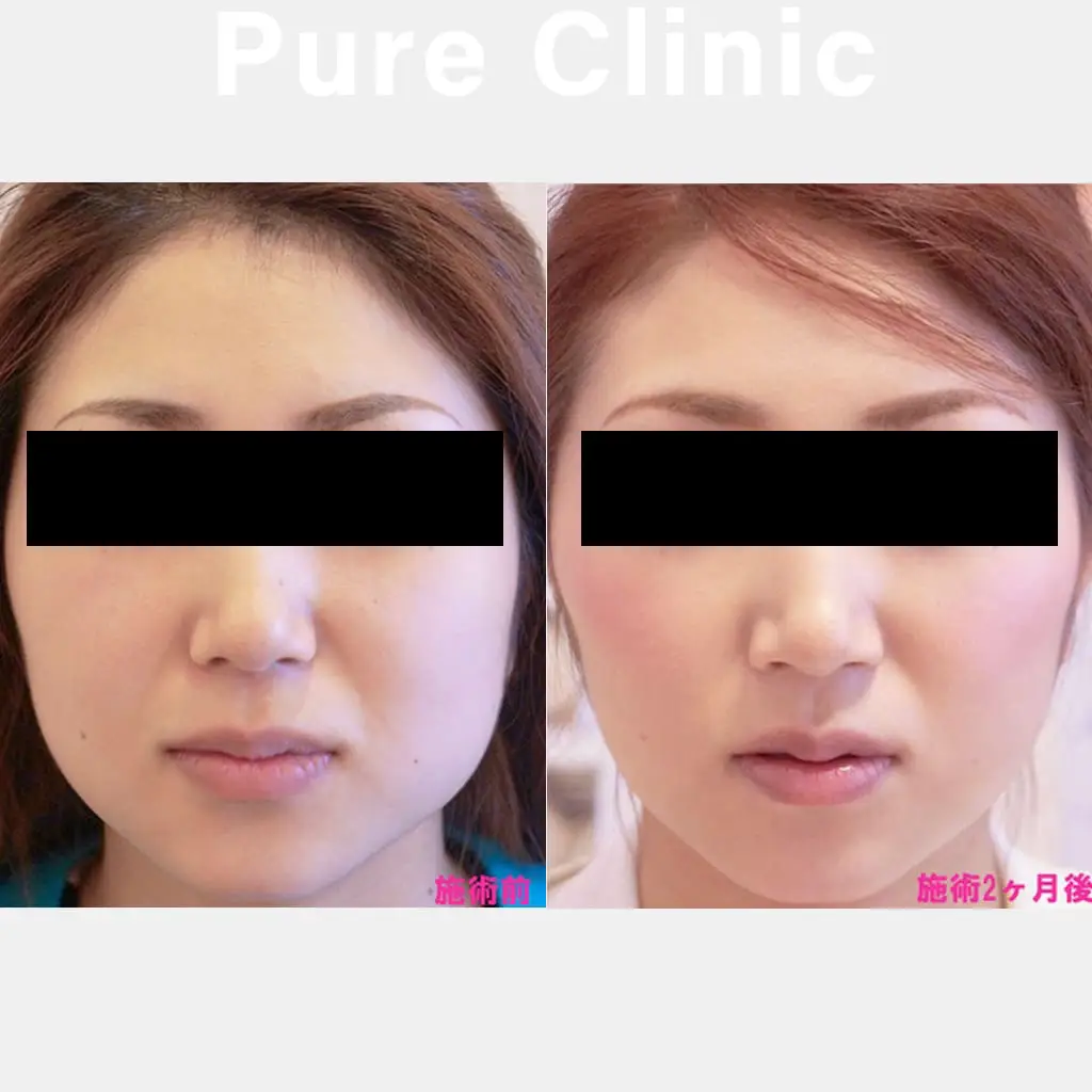 ボツリヌストキシン製剤によるエラの改善