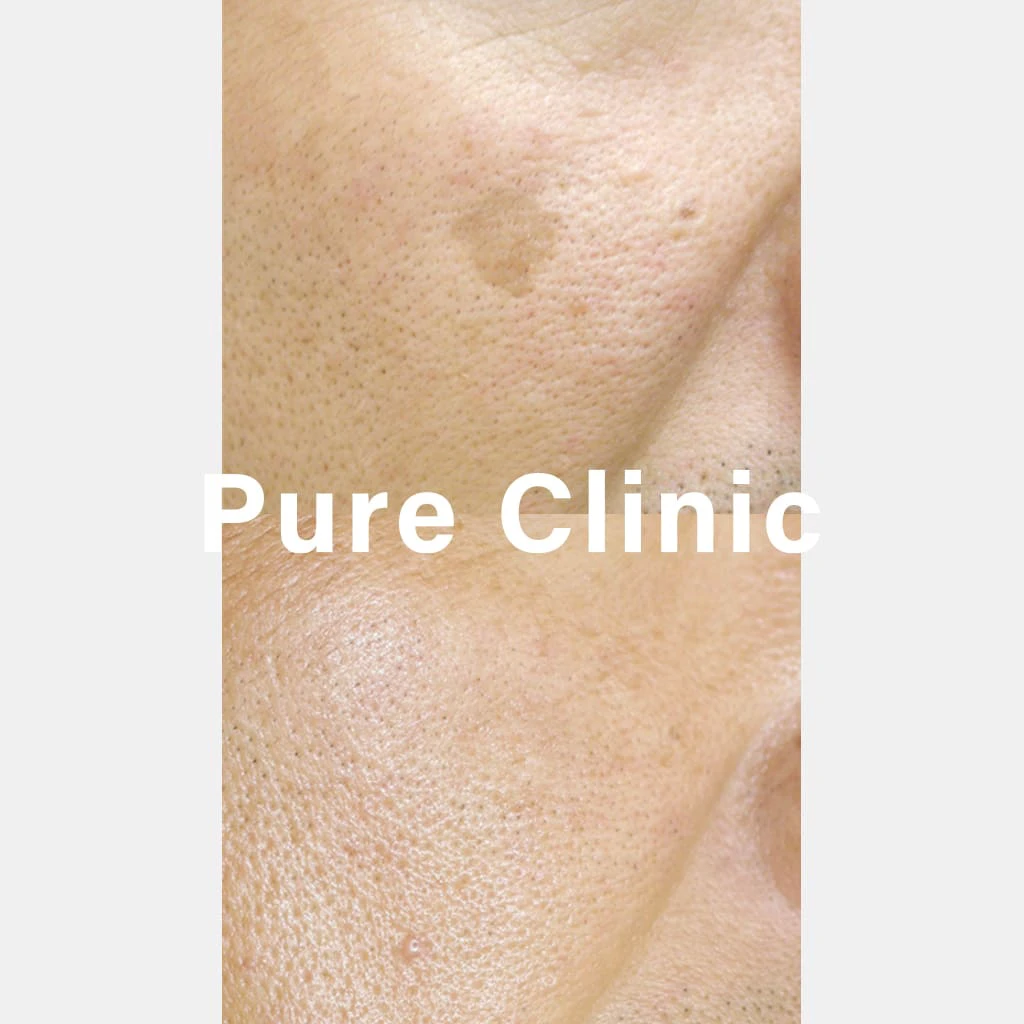 しみ取りレーザー