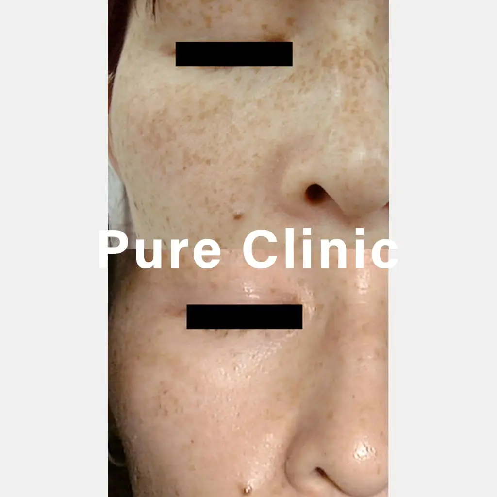 しみ取りレーザーによるしみの改善