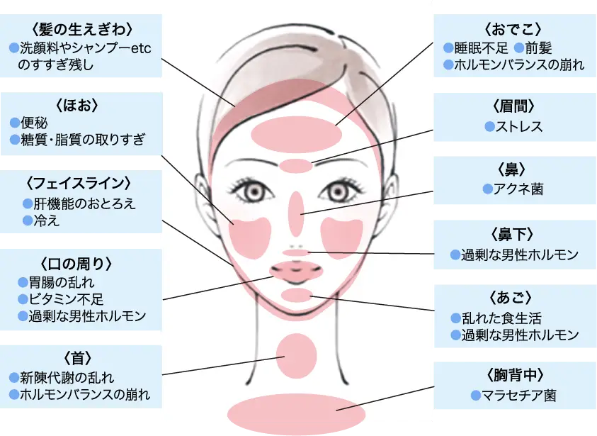 ニキビはどうしてできるの？