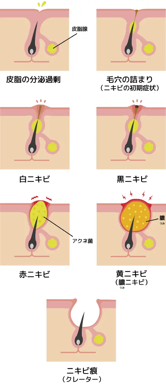 ニキビのでき方