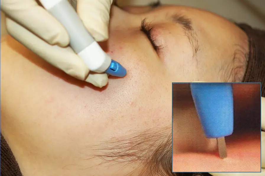 アグネス治療イメージ