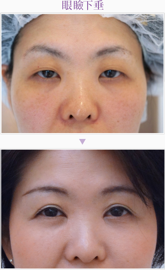 眼瞼下垂